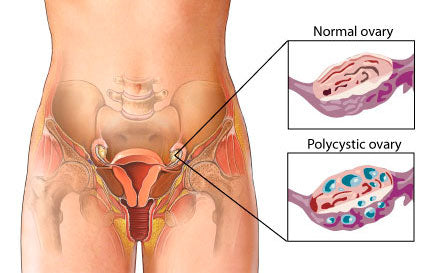 Diagram comparing a normal ovary and a polycystic ovary